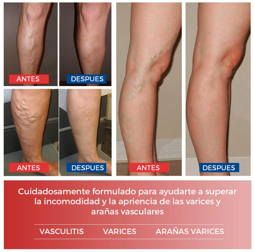 NUEVO SET DE PARCHES PARA VENAS VARICES